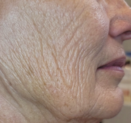 Ρυτίδες Before